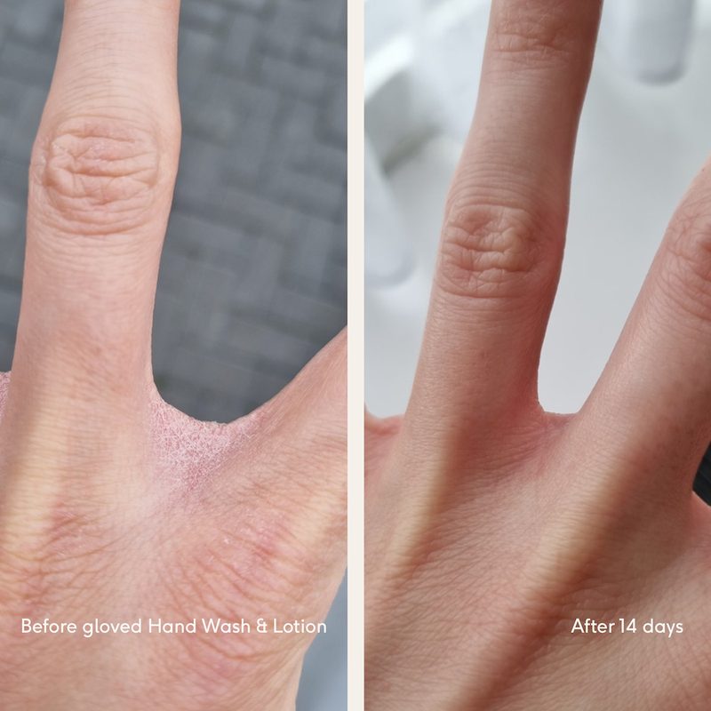 Louise's hands before and after 14 days